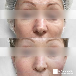 Контурная пластика препаратом Radiesse
