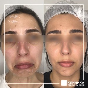 Ботулинотерапия