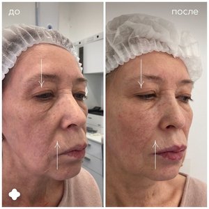 Контурная пластика лица