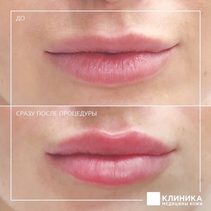 Контурная пластика губ