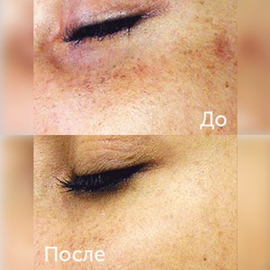 HydraFacial програма революционное омоложение