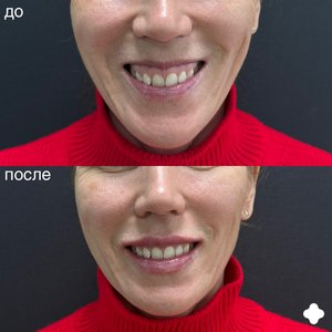 Коррекция десневой улыбки