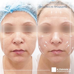 Ультразвуковой СМАС-лифтинг Ulthera