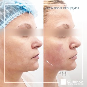 Ultherapy пациент ЕА