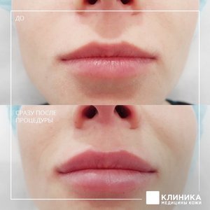Контурная пластика губ