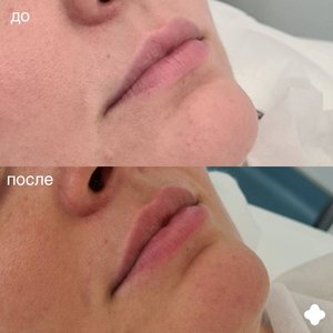 Контурная пластика губ