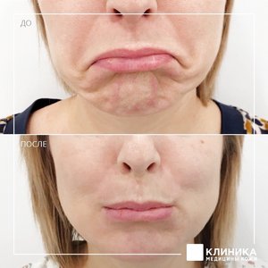Ботулинотерапия подбородок