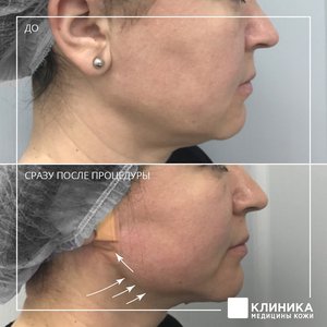 Мезонити