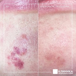 Лазерное удаление сосудов
