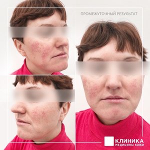 Микротоковая терапия розацеа