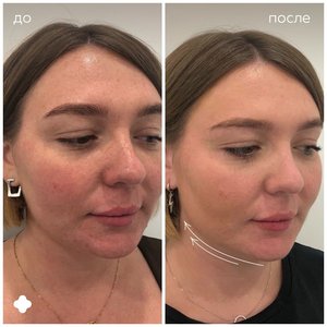 Контурная пластика скул
