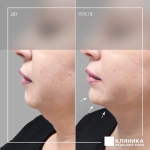 Контурная пластика подбородка