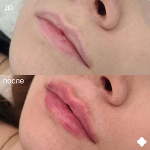 Контурная пластика губ