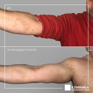 Лечение атопического дерматита