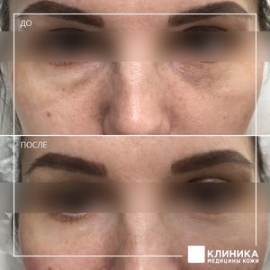 Контурная пластика темные круги