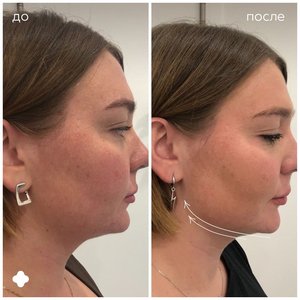 Контурная пластика нижней челюсти и скул