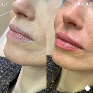 Контурная пластика губ