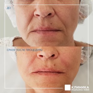 Контурная пластика носогубных складок