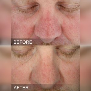 HydraFacial программа глубокое очищение