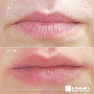 Контурная пластика губ