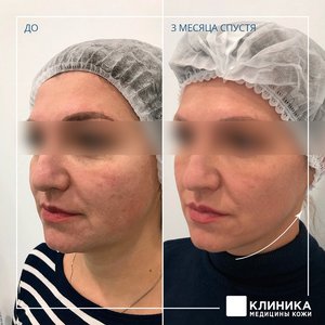 Ультразвуковой СМАС-лифтинг Ulthera