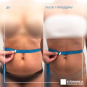 Криолипосакция
