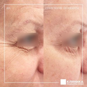 Ультразвуковой СМАС-лифтинг Ulthera
