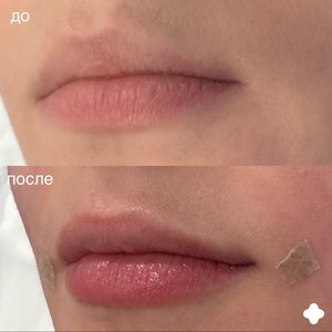 Контурная пластика губ