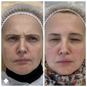 Ботулинотерапия