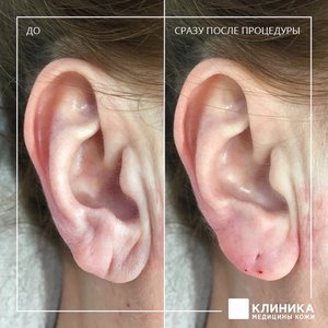 Контурная пластика ушей