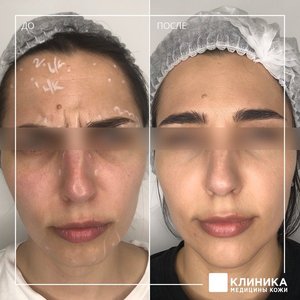 Ботулинотерапия