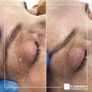 Удаление папилломы на глазу