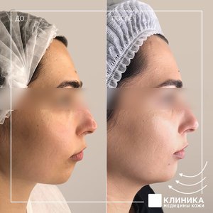 Контурная пластика подбородка