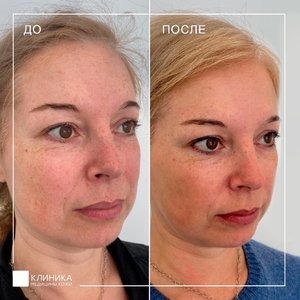 Фотоомоложение М22