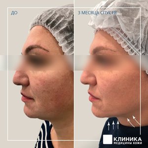 Ультразвуковой СМАС-лифтинг Ulthera