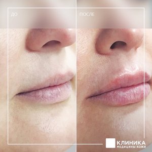 Контурная пластика губ