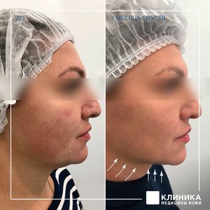 Ультразвуковой СМАС-лифтинг Ulthera