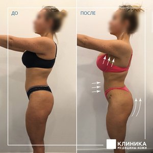 Коррекция фигуры LPG + RF лифтинг