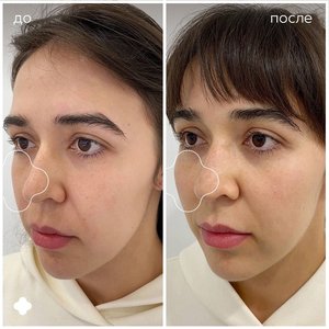 Контурная пластика скул и подбородка