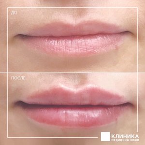 Контурная пластика губ