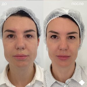 Ботулинотерапия full face