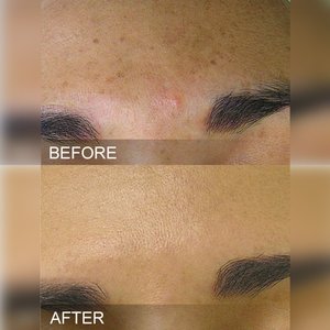 HydraFacial программа революционное омоложение