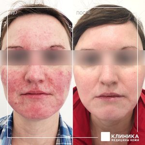 Микротоковая терапия розацеа