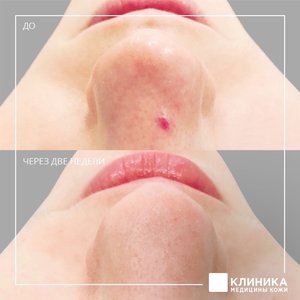 Лазерное удаление сосудов
