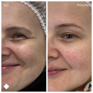 Ботулинотерапия