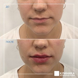 Контурная пластика губ