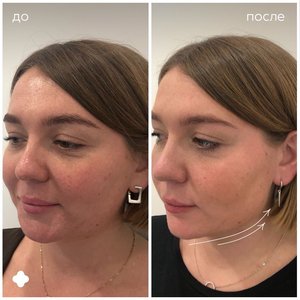 Контурная пластика подбородка