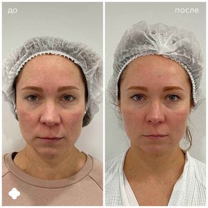 Фотоомоложение Lumenis M22