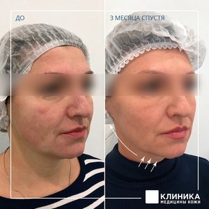 Ультразвуковой СМАС-лифтинг Ulthera