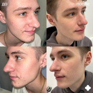 Лечение акне